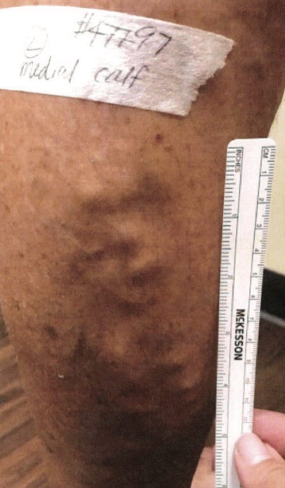 Veins in left thigh and ruler pre-treatment