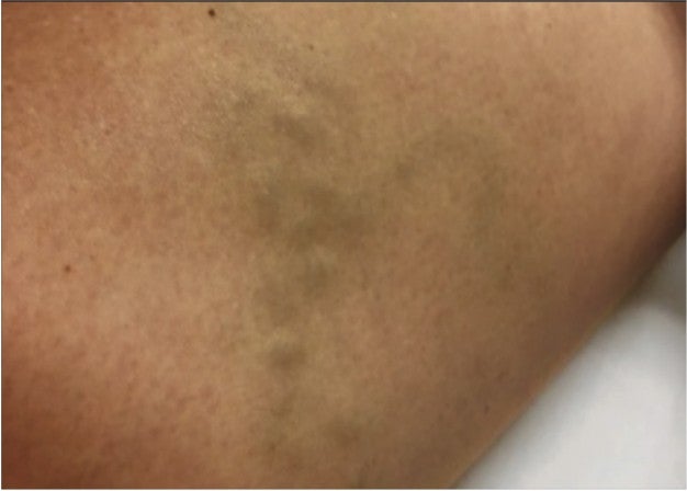 Right tributary showing varicosity, illustrating the area affected by venous disease.