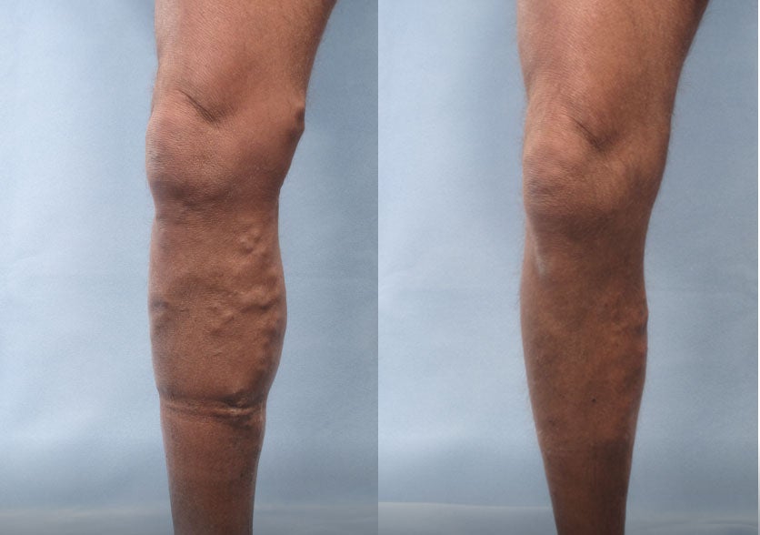 Before-and-after comparison of a patient treated with Varithena, highlighting the notable reduction in varicose veins and improvement in skin appearance.