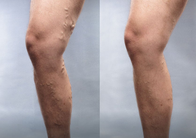 Before-and-after comparison of a patient treated with Varithena, illustrating visible improvements in varicose veins.