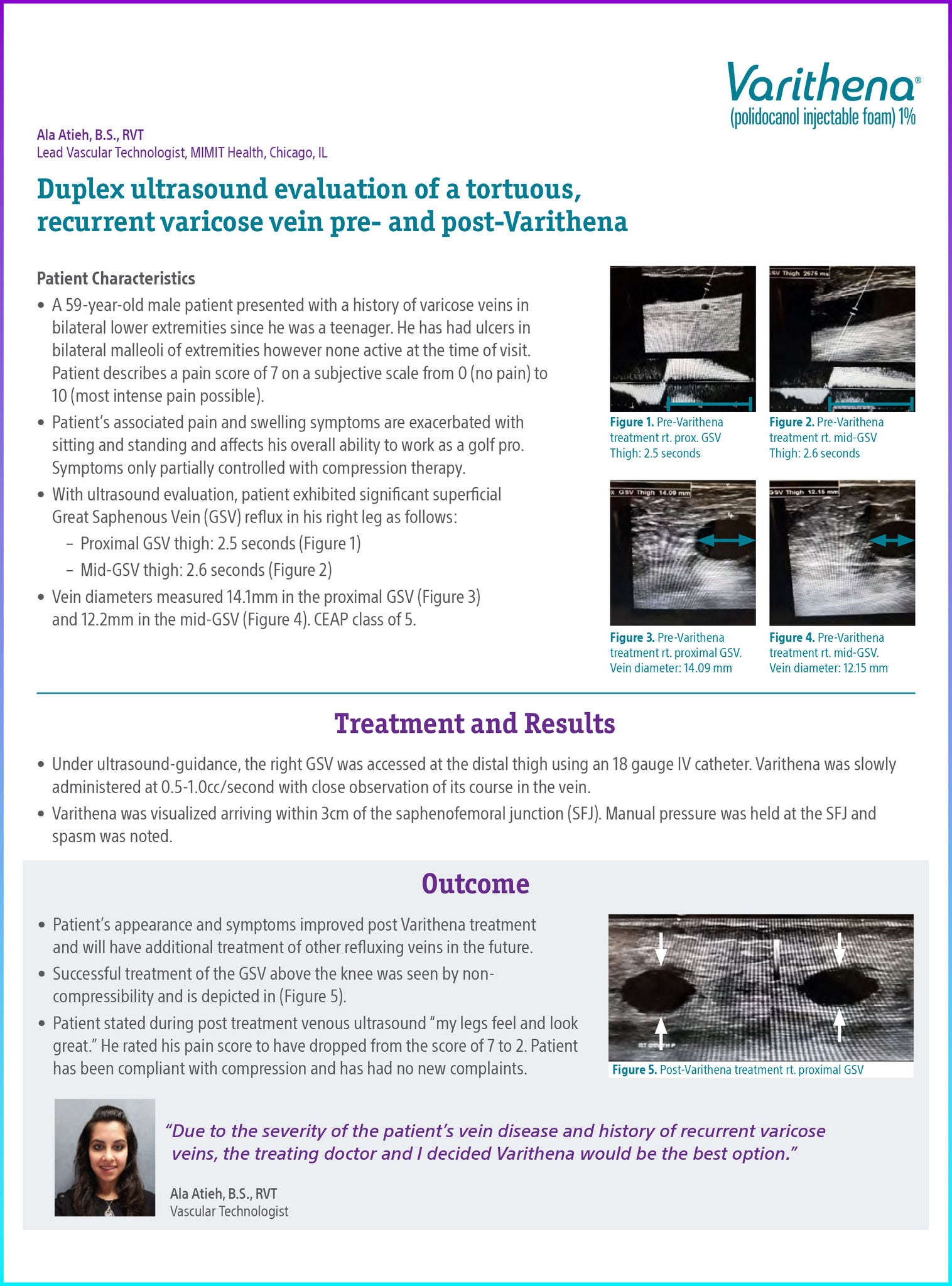 Duplex ultrasound evaluation of a tortuous, recurrent varicose vein pre- and post-Varithena