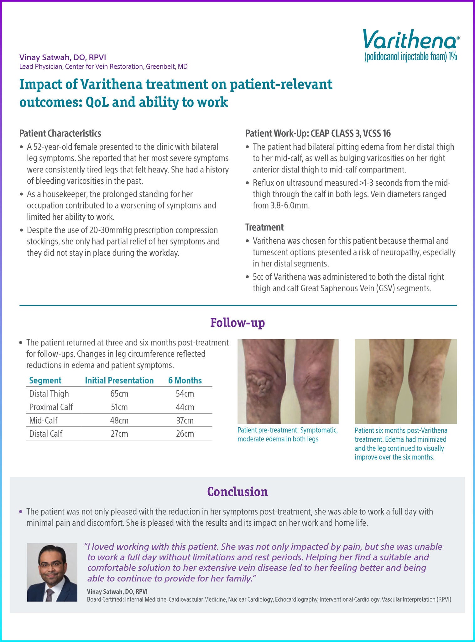 Case study by Satwah detailing the success of Varithena in treating varicose veins, with significant improvements in patient symptoms and well-being.