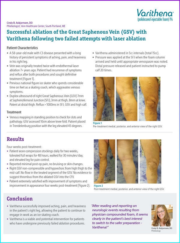 Case study by Asbjornsen demonstrating the positive outcomes of Varithena treatment in managing Vvaricose vein symptoms and patient quality of life.