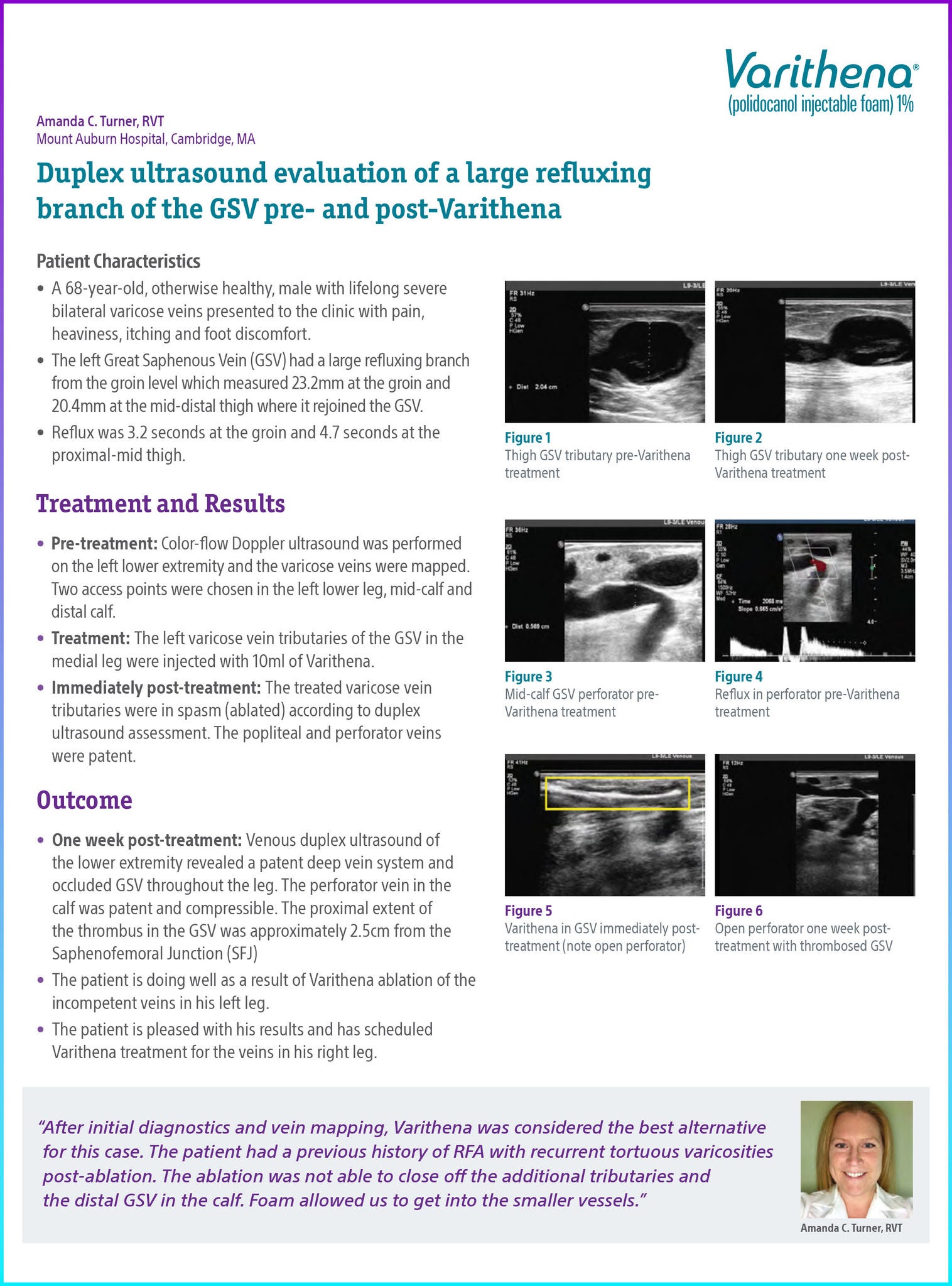 Duplex ultrasound evaluation of a large refluxing branch of the GSV pre- and post-Varithena