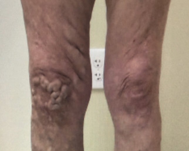 Lower legs and knees pre-treatment