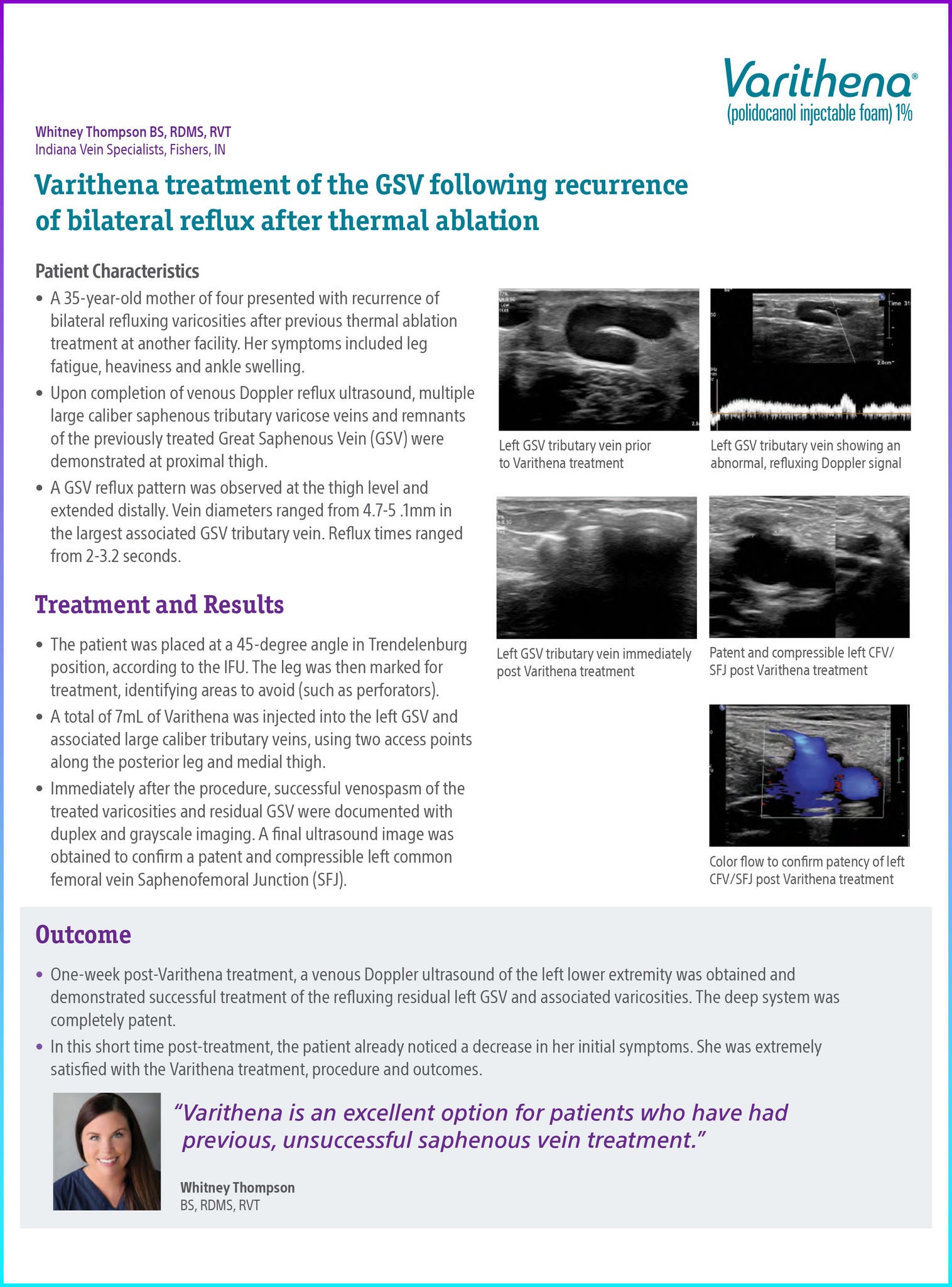 Case study by Thompson illustrating the effectiveness of Varithena in alleviating varicose vein symptoms and enhancing patient outcomes.