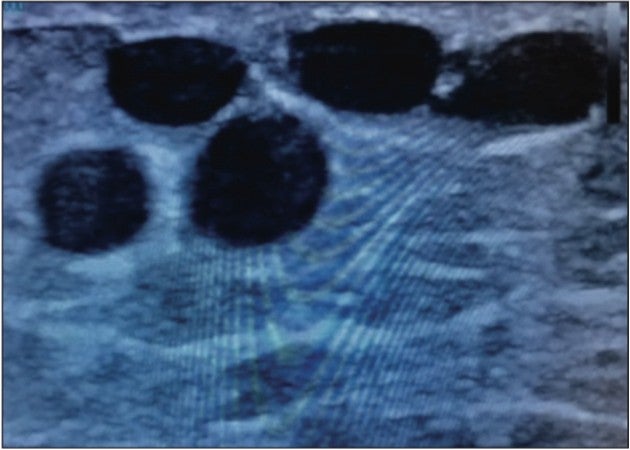 Varicosity above the knee before treatment with Varithena, illustrating the severity of the condition.