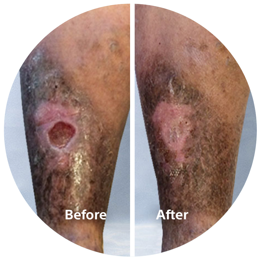 Before andafter comparison of a patient treated with Varithena, illustrating visible improvements leg ulcer.s.