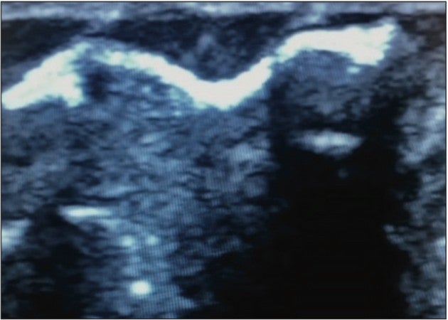 Demonstrating the process of filling the vein with Varithena during the treatment.