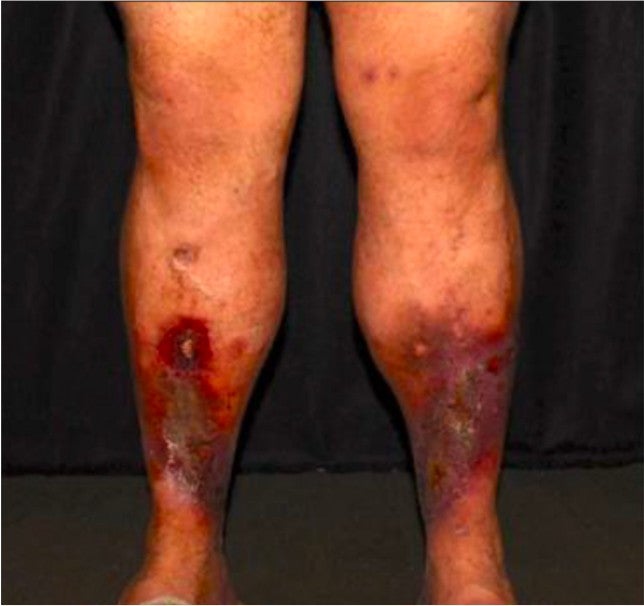 Patient's leg condition before Varithena treatment, highlighting visible varicosities in the affected area.