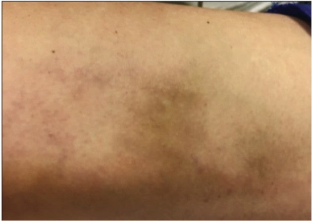 Patient's leg condition after Varithena treatment, showcasing significant improvements in the appearance of veins.