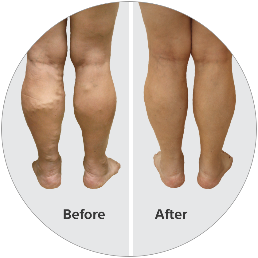 Back of legs showing before and after Varithena treatment.