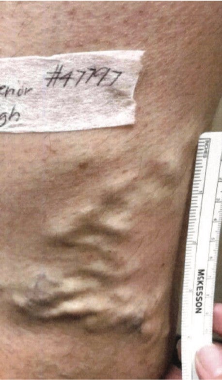 Veins in left thigh and ruler pre-treatment