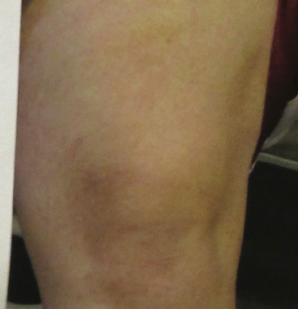 Left GSV Post-treatment