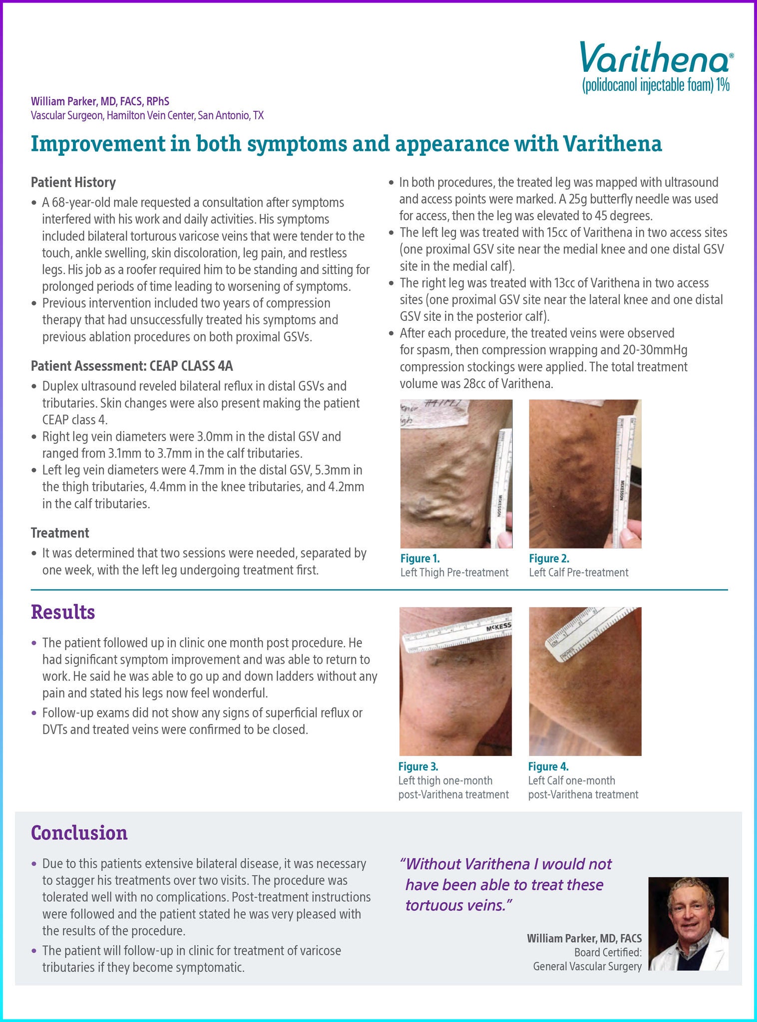 Improvement in both symptoms and appearance with Varithena.