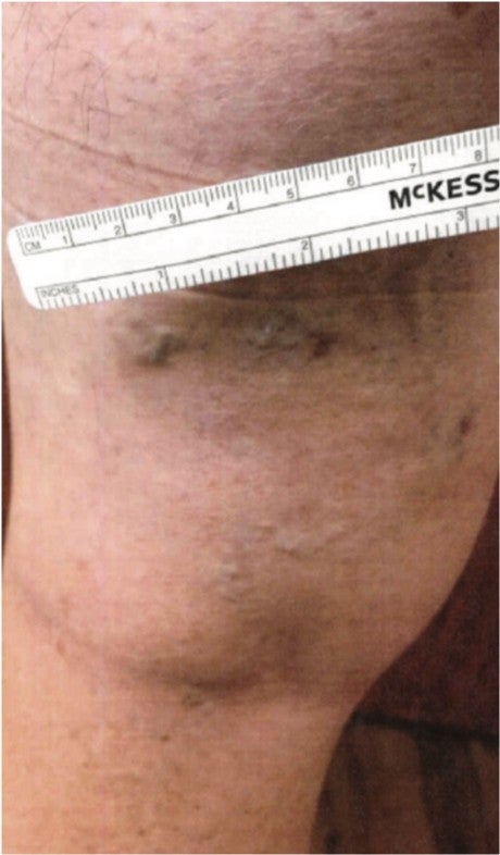 Left Thigh One-Month Post-Varithena Treatment and rule