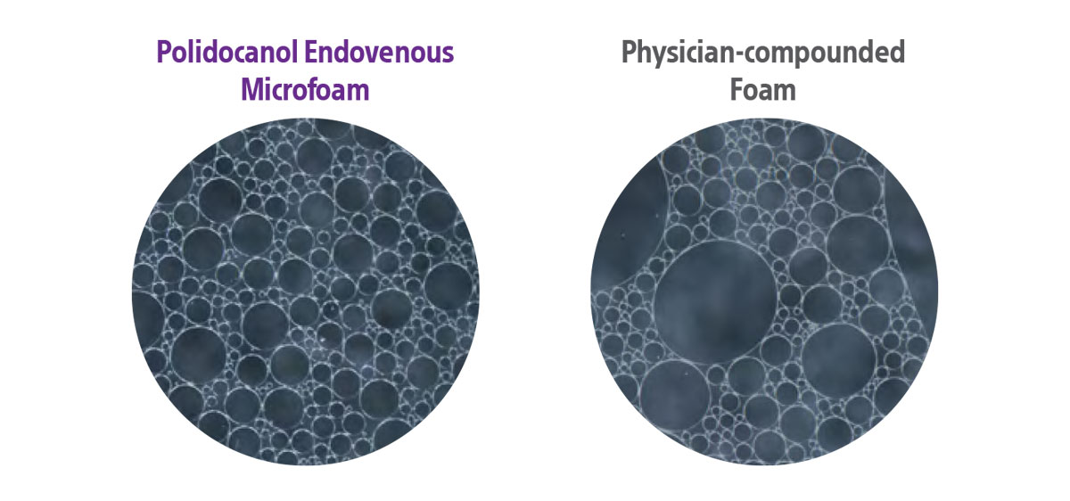 Polidocanol endovenous microfoam and physician-compounded foam bubbles in black circles.