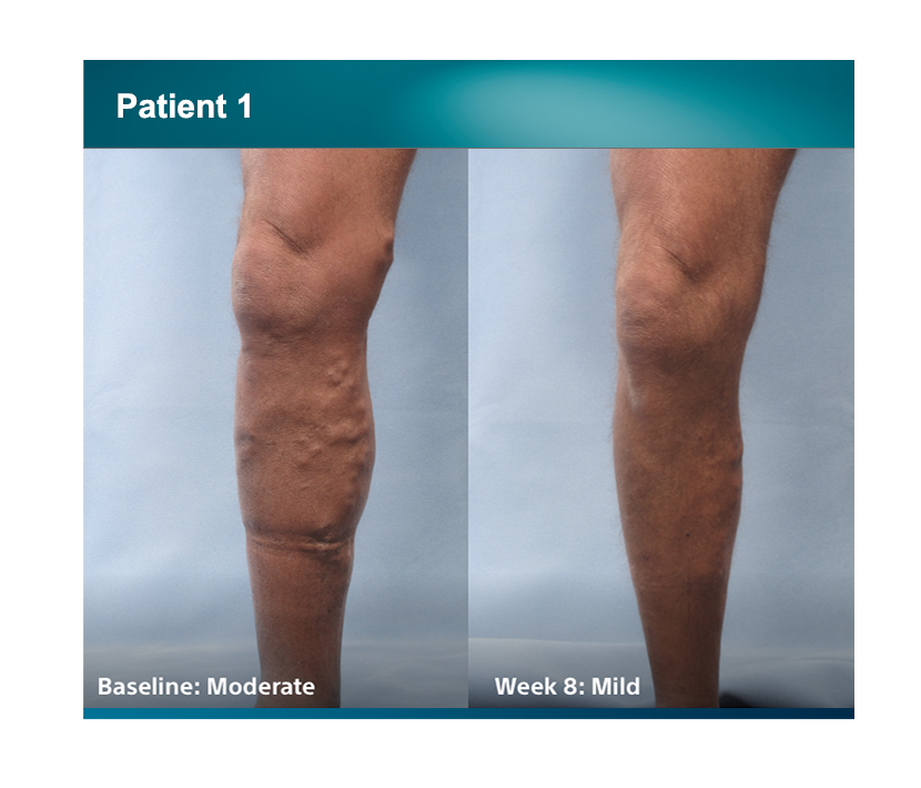 Patient 1 legs comparison baseline moderate, week 8 was mild