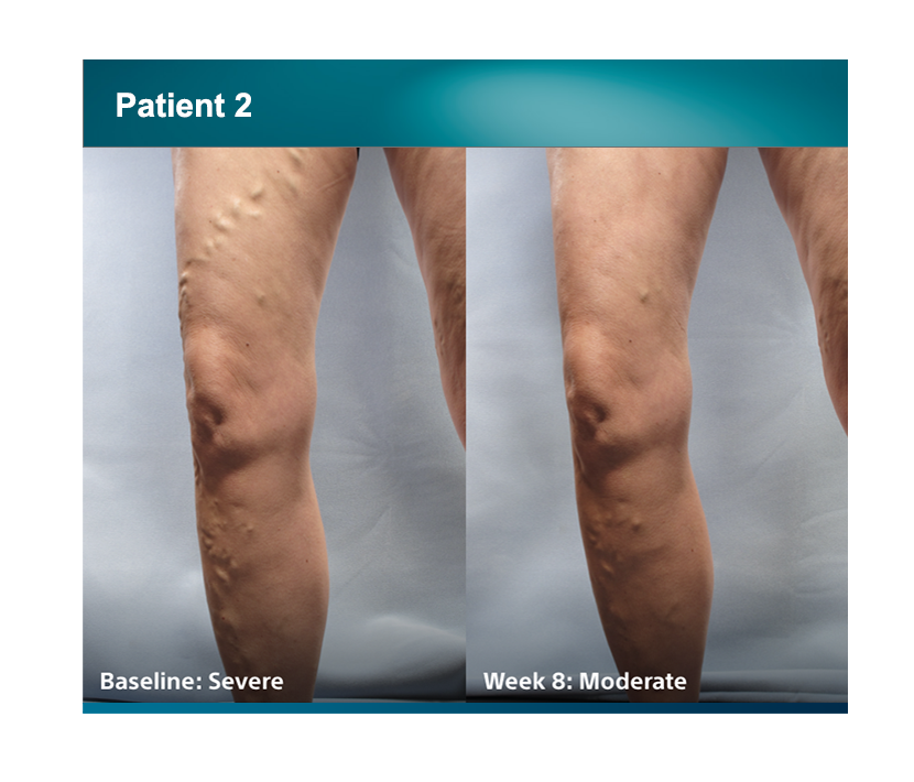Patient 2 legs comparison baseline severe, week 8 was moderate