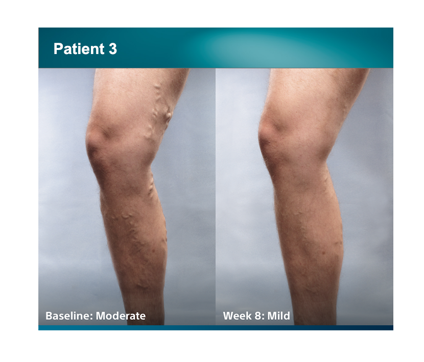 Patient 3 legs comparison baseline moderate, week 8 was mild
