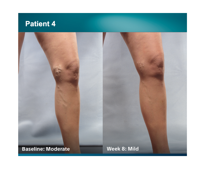Patient 4 legs comparison baseline moderate, week 8 was mild