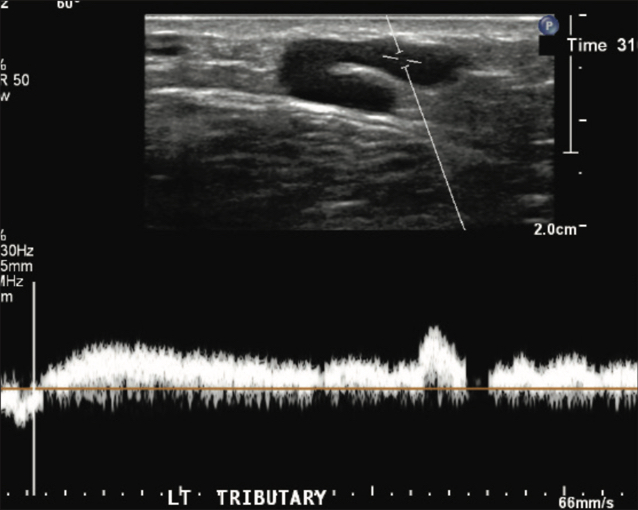 Ultrasound of left GSV tributary vein showing an abnormal, refluxing Doppler signal