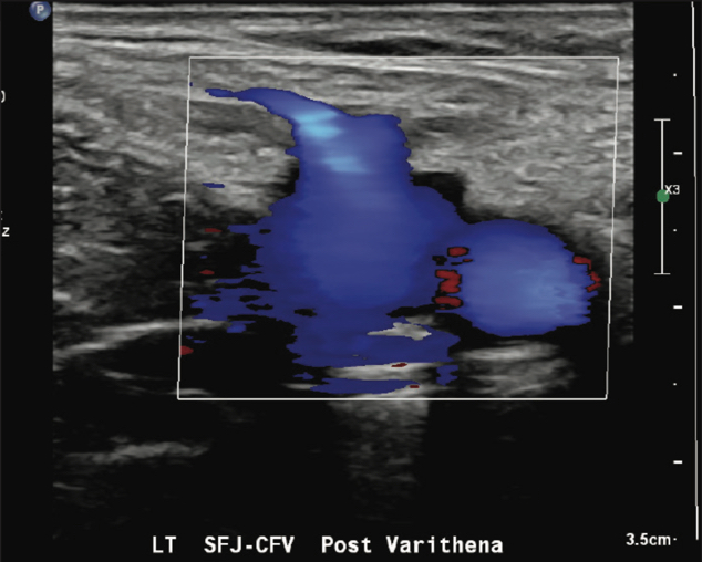 Ultrasound of Color flow post Varithena treatment