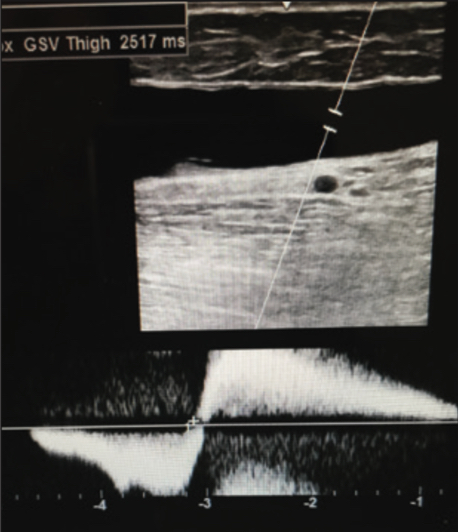 Ultrasound of Varithena pre-treatment