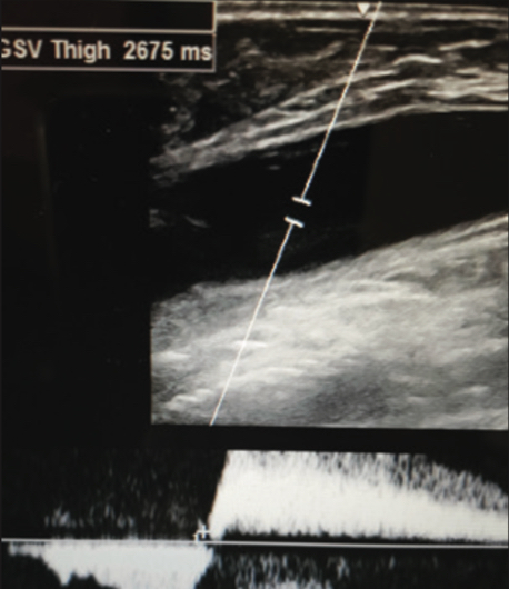 Ultrasound of Varithena pre-treatment