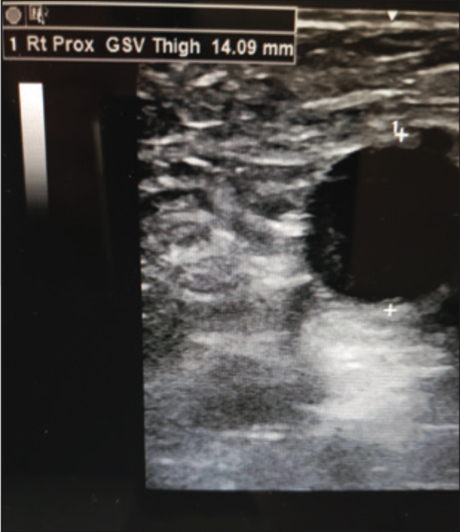 Ultrasound of Varithena pre-treatment