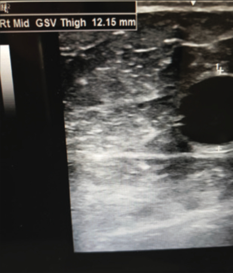 Ultrasound of Varithena pre-treatment