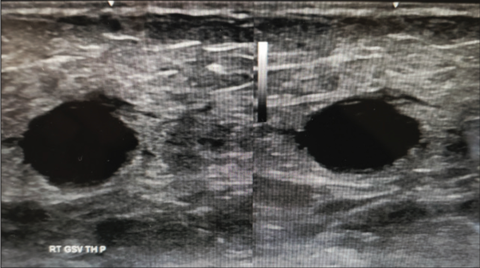 Ultrasound of Varithena post-treatment