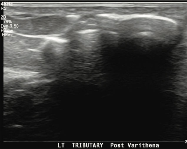 Ultrasound of left GSV tributary vein immediately post Varithena treatment