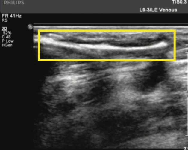 Varithena in GSV immediately post-treatment (note open perforator)