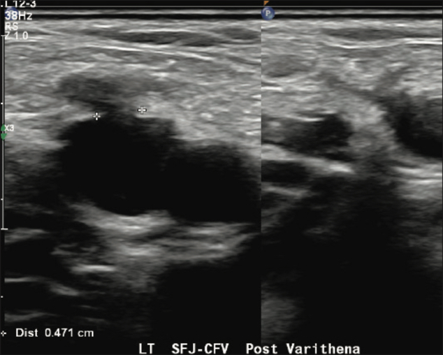 Ultrasound post-varithena treatment