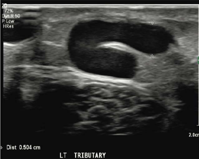 Ultrasound of left GSV tributary vein prior to Varithena treatment