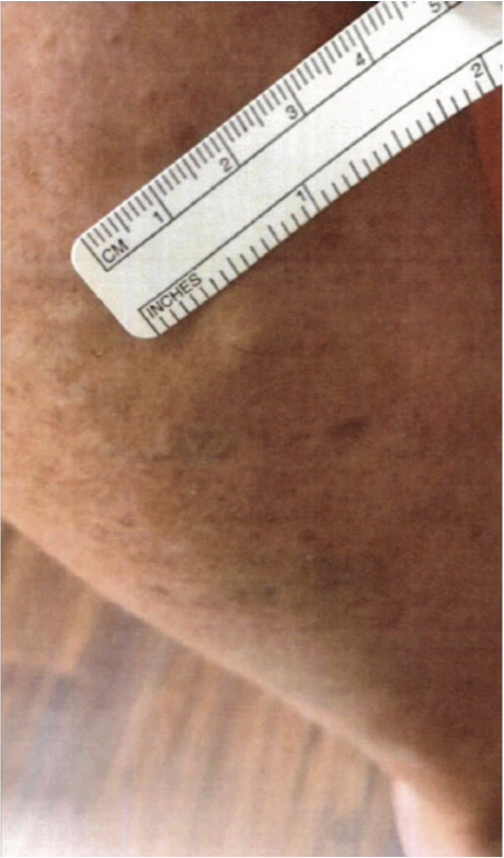 Left Thigh One-Month Post-Varithena Treatment and ruler