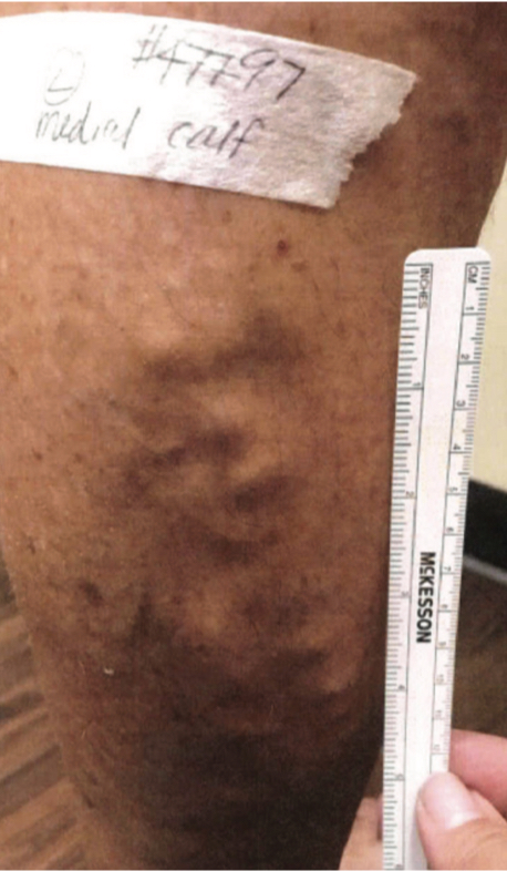 Veins in left thigh and ruler pre-treatment