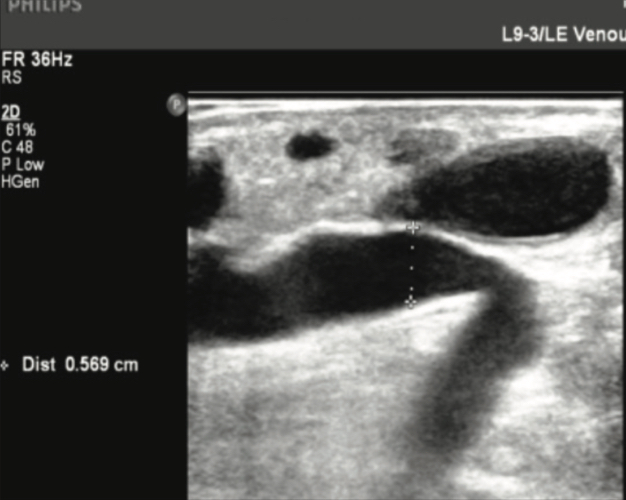 Mid-calf GSV perforator pre-Varithena treatment