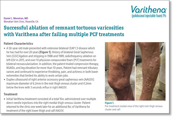 Case study first page with title and images of varicosities legs