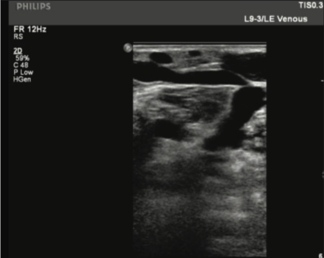 Open perforator one week post-treatment with thrombosed GSV