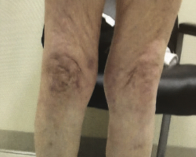 Lower legs and knees post-treatment