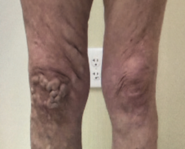 Lower legs and knees pre-treatment