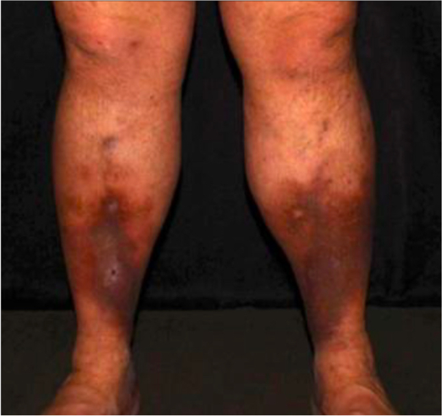 ulcers on legs post treatment