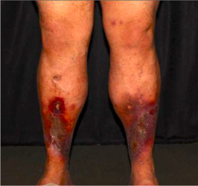 legs with ulcers pre-treatement