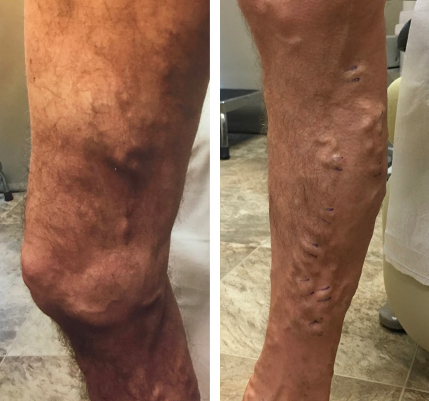 two leg with bulging veins