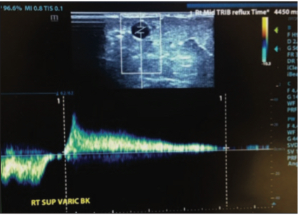 Ultrasound scan of knee varicosity