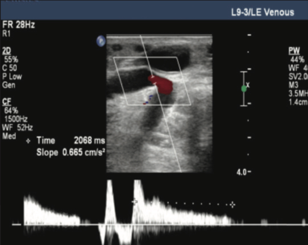 Ultrasound of reflux in perforator pre-Varithena treatment