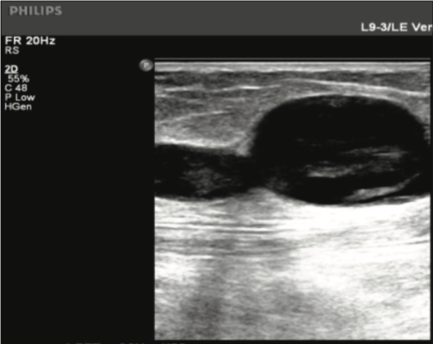 Ultrasound of thigh with GSV tributary one week post- Varithena treatment