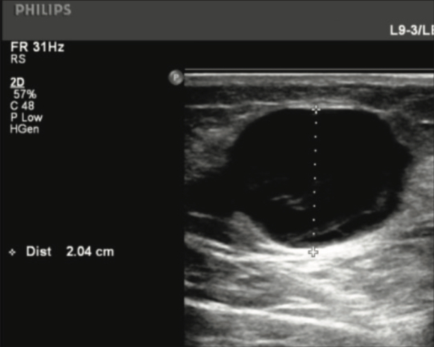 Ultrasound of GSV Tributary pre-Varithena treatment